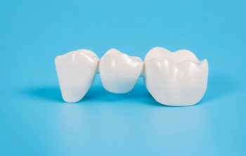 What Is the Durability of Dental Crowns and Bridges?