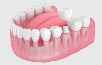 Replacing Old Crowns: Signs and Considerations for Renewal